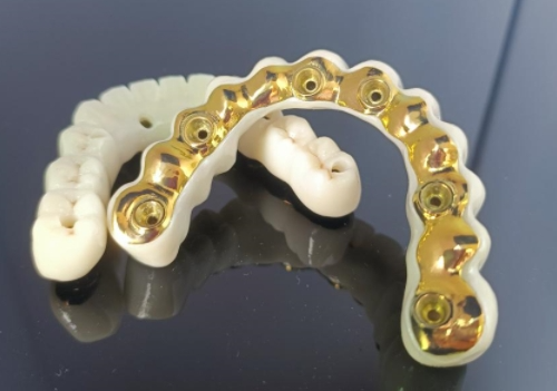 CAD / CAM titano implantų juosta + cirkonio tiltas