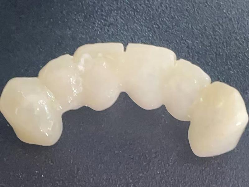 Kas yra „Laikinoji karūna“? Kodėl jums to reikia?