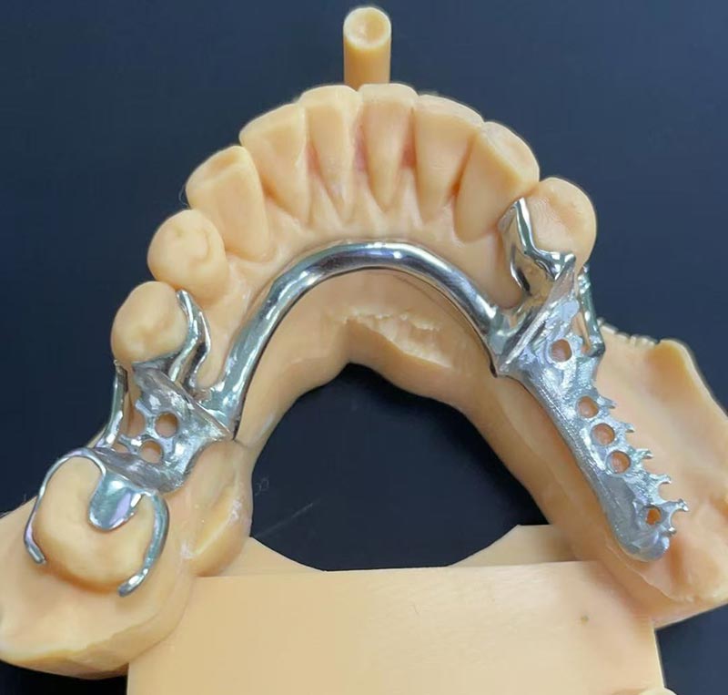 Kobalto ir chromo sistemos privalumai (Co Cr Framework)
