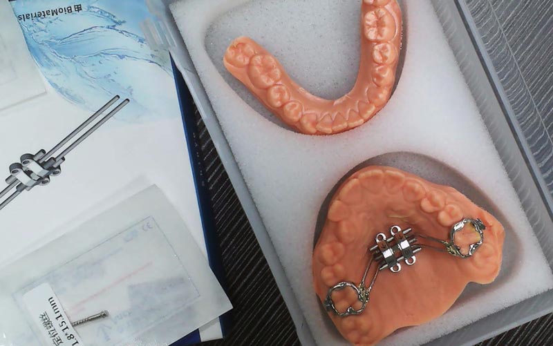 Supraskite MSE skeleto plėtrą su WM Dental Lab