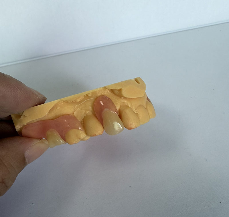 „Valplast Partials“ WM dantų laboratorijoje