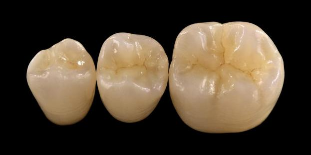 <h2>Cirkonis odontologijoje: indikacijos, pranašumai ir klinikinės aplinkybės</h2>
<p>Cirkonis yra plačiai pripažintas dėl savo stiprumo ir ilgaamžiškumo. Naujausios kartos cirkonio oksido medžiagos taip pat pasižymi žymiai patobulintomis estetinėmis savybėmis. Pacientams, svarstantiems apie visos keramikos restauravimą, labai svarbu atidžiai įvertinti cirkonio oksido sistemų indikacijas ir apribojimus.</p>
<p>Šiuolaikiniai pacientai vis dažniau tikisi restauracijų, kuriose puiki estetika derinama su visapusiška funkcionalumu. Dauguma šiuolaikinių keraminių sistemų gali patenkinti šiuos lūkesčius, tačiau klinikinė sėkmė daugiausia priklauso nuo tinkamo medžiagos parinkimo, dantų paruošimo ir cementavimo protokolų. Renkantis reikia vadovautis pagrindinėmis medžiagos savybėmis, tokiomis kaip atsparumas lūžiams, atsparumas lenkimui, atsparumas dilimui ir ilgalaikis stabilumas. Tarp šių medžiagų cirkonis tapo vienu iš plačiausiai naudojamų šiuolaikinės restauracinės odontologijos galimybių.</p>
<h3>Kodėl verta rinktis cirkonį?</h3>
<p>Cirkonis vertinamas dėl išskirtinio stiprumo ir ilgalaikio patvarumo. Šiuolaikinis cirkonis labai skiriasi nuo ankstesnių kartų, kurie buvo neskaidresni ir mažiau estetiški. Šiandien CAD/CAM technologija leidžia tiksliai pagaminti cirkonio oksido restauracijas su patobulintomis optinėmis savybėmis.</p>
<p>Restauracijos gali būti suprojektuotos taip:</p>
<ul>
<li><strong>Monolitinis cirkonis:</strong>Idealiai tinka užpakalinėms karūnėlėms ir tiltams, pasižymi dideliu tvirtumu ir ilgaamžiškumu.</li>
<li><strong>Sluoksniuotas cirkonis:</strong>Tinka atvejams, kuriems reikalinga patobulinta estetika, įskaitant ilgaamžiškumą įvairiose burnos vietose.</li>
</ul>
<p>Lenkimo stipris skiriasi priklausomai nuo tipo ir svyruoja nuo maždaug 590 MPa didelio permatomo cirkonio oksido iki 1400 MPa monolitinės formos. Cirkonio oksido restauracijos gali būti cementuojamos naudojant lipnius dervos cementus arba derva modifikuotus stiklo jonomerinius cementus.</p>
<h3>Pagrindiniai cirkonio oksido medžiagų pasirinkimo veiksniai</h3>
<p>Svarstydami cirkonio oksido naudojimą visos keramikos restauravimui, gydytojai turėtų įvertinti kelis svarbius veiksnius:</p>
<ul>
<li>Likusi danties struktūra</li>
<li>Vieta burnos ertmėje (estetinė zona vs funkcinė zona)</li>
<li>Parafunkcinių įpročių, tokių kaip bruksizmas, buvimas</li>
<li>Šalia esančių natūralių dantų skaidrumas</li>
<li>Pagrindinės danties struktūros spalva ir būklė</li>
</ul>
<p>Estetinė zona paprastai apima priekinius dantis, nors kai kuriems pacientams ji gali nusitęsti iki pirmojo krūminio danties, priklausomai nuo šypsenos linijos ir veido dinamikos. Funkcinė zona paprastai apima prieškrūminius ir krūminius dantis, kur sąkandžio jėgos yra žymiai didesnės.</p>
<h3>Funkcinės zonos programos</h3>
<p>Užpakalinėse srityse reikia atidžiai apsvarstyti sąkandžio jėgas. Cirkonis yra puiki alternatyva tradicinėms PFM restauracijoms, ypač tais atvejais, kai restauracinė erdvė yra ribota. Šiuolaikinis monolitinis cirkonis leidžia sukurti visą sąkandžio anatomijos kontūrą, įskaitant funkcinius kaušelius ir kraštines briaunas, išlaikant didelį stiprumą.</p>
<p>Dabartiniai įrodymai rodo, kad monolitinis cirkonis puikiai tinka užpakalinėms karūnėlėms ir kelių blokų tiltams dėl puikaus atsparumo lūžiams ir nusidėvėjimui. Klijų metodų ir paruošimo dizaino pažanga taip pat pagerino ilgalaikius klinikinius rezultatus.</p>
<h3>Estetinės zonos pritaikymas</h3>
<p>Priekinėje srityje restauracijos turi tiksliai atkartoti natūralią dantų spalvą, skaidrumą ir šviesą. Nors tokios medžiagos kaip ličio disilikatas pasižymi puikia estetika, jos yra mažiau tvirtos ir paprastai reikalauja klijų.</p>
<p>Pagrindinis cirkonio oksido privalumas yra jo gebėjimas įprastu būdu sucementuoti, išlaikant aukštas estetines savybes. Sukūrus didelio skaidrumo ir daugiasluoksnes cirkonio oksido sistemas, dabar galima gaminti restauracijas, kurios labai imituoja natūralų dantų sąnarį.</p>
<p>Pažangios apdorojimo technologijos dar labiau pagerina optines savybes ir sumažina netobulumus, kurie gali turėti įtakos šviesos pralaidumui ir išvaizdai.</p>
<h3>Jėga ir estetika kartu</h3>
<p>Ankstyvosios cirkonio sistemos pirmenybę teikė stiprumui, tačiau trūko estetinės kokybės. Šiuolaikinis monolitinis cirkonis sėkmingai derina tvirtumą ir patobulintą išvaizdą, todėl tinka įvairiems klinikiniams atvejams.</p>
<p>Jis ypač naudingas pacientams, turintiems parafunkcinių įpročių arba anksčiau patyrusiems atkūrimo nesėkmes. Klinikiniai tyrimai rodo didelį pacientų priėmimą ir mažą komplikacijų skaičių.</p>
<p>Susirūpinimas dėl priešingų dantų susidėvėjimo sumažėjo naudojant naujesnes formules. Labai poliruoti cirkonio oksido paviršiai pasižymi mažu abrazyviniu potencialu ir kai kuriais atvejais gali būti švelnesni nei tradicinės porceliano, lydyto su metalu, restauracijos.</p>
<h3>Cirkonio implantai: nauja alternatyva</h3>
<p>Nors titano implantai išlieka klinikiniu standartu, cirkonio oksido implantai sulaukia dėmesio kaip alternatyva be metalų. Ankstyvieji dizainai daugiausia buvo vientisos sistemos, tačiau dabar dviejų dalių cirkonio oksido implantai leidžia pagerinti protezavimo lankstumą.</p>
<p>Cirkonio oksido implantai yra ypač naudingi tais atvejais, kai kyla estetinių problemų, pvz., galimas pilkos spalvos pakitimas periimplanto audiniuose arba plonas dantenų biotipas. Jie taip pat gali būti skirti pacientams, kuriems yra retas jautrumas titanui.</p>
<p>Tačiau cirkonio implantai vis dar yra palyginti nauji, o ilgalaikiai klinikiniai duomenys, palyginti su titano sistemomis, išlieka riboti.</p>
<h3>Išvada</h3>
<p>Cirkonis tapo labai universalia restauracinės odontologijos medžiaga, siūlančia tvirtą pusiausvyrą tarp mechaninių savybių ir estetikos. Tinkamas atvejo pasirinkimas ir klinikinių protokolų laikymasis yra būtini norint pasiekti optimalių rezultatų tiek priekinėje, tiek užpakalinėje programoje.</p>